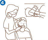 PMTCとフッ素塗布