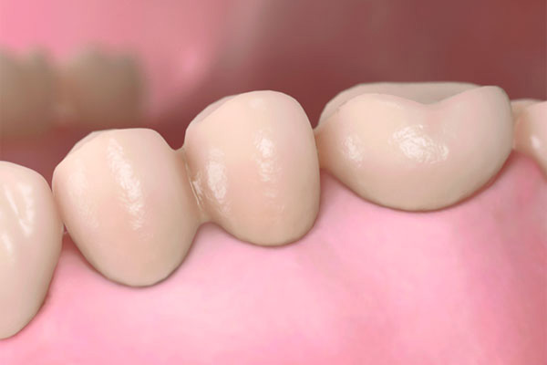 仮歯を作製し問題が無ければきちんとした被せ物を作製し装着後はメンテナンスに