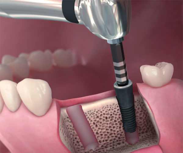インプラントフィクスチャーの埋入